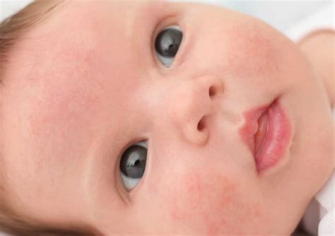 Bebeklerde Alerjik Reaksiyon Belirtileri ve Önlemler